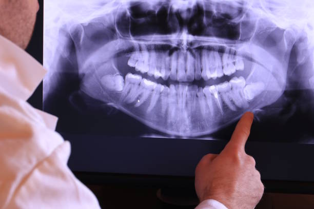 Best Knocked-Out Tooth (Avulsed Tooth) Treatment in Lebanon, NH